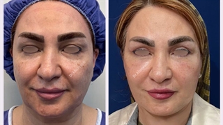 رضایت بیمار عزیز 3ماه پس از عمل لیفت صورت و عمل پلک بالا