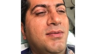 رفع افتادگی پلک آقای جوان و حیرت ایشان!!