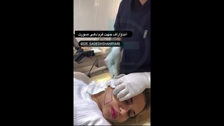 درمان آکنه اسکار با دستگاه پزشکی Endo-RF Subcision