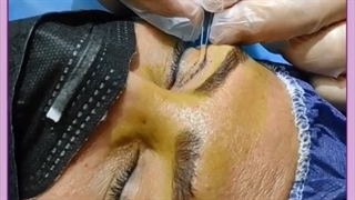 جراحی زیبایی پلک یا بلفارپلاستی