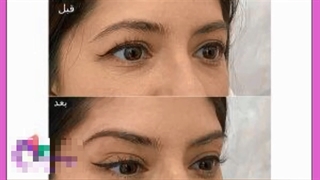 علت درشت شدن چشم ها چیست؟