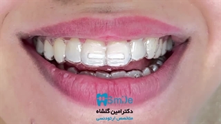 الاینر ارتودنسی