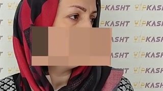 نتیجه بلافاصله بعد از کاشت ابرو- کلینیک vip تهران