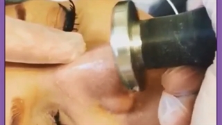 لیفت بینی یا جراحی؟