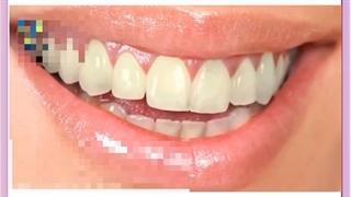 کاربرد لمینت دندان بلیچینگ دندان