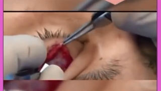 دکتر خوب برای افتادگی پلک در کل ایران فقط دکتر علیزاده