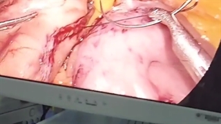 راهکارهای لازم جهت جلوگیری از شل شدن پوست بعد عمل چاقی