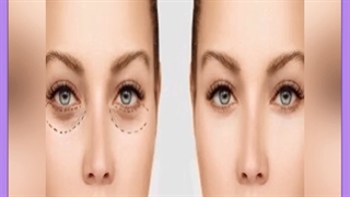 هزینه درمان پف زیر چشم با لیزر چقدر است؟