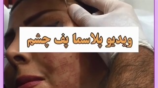 بهترین راه آرایش چشم پف دار و پلک افتاده چیست؟