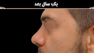 قبل و یکسال بعد از عمل زیبایی بینی | دکتر امید ابراهیمی
