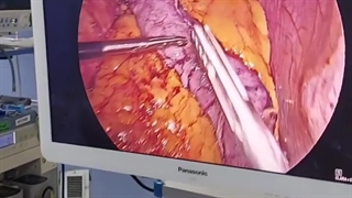 جراحی اسلیو مجدد