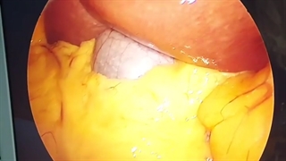 جراحی چاقی و سنگ کیسه صفرا بطور همزمان