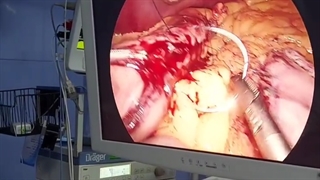 مدت زمان مصرف ویتامین و مکمل بعد از جراحی چاقی