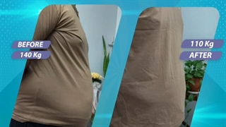 قبل و بعد از جراحی چاقی