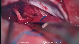 عمل جراحی تومور مننژیوم پتروکلایوال