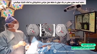 تخلیه آبسه مغزی عمقی