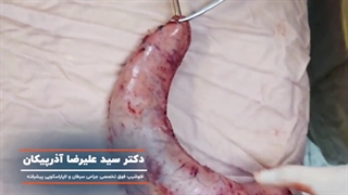 دمیدن هوا در معده خارج شده در جراحی اسلیو