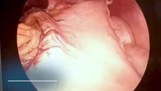 اسلیو معده به علت چاقی مجدد بعد از دو بار جراحی بالون معده