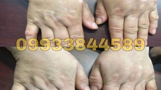 درمان قطعی پیس یا برص