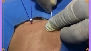 فیلم لیفت صورت با نخ توسط دکتر علیزاده