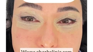 عمل افتادگی پلک
