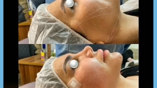 لیفت صورت با جراحی یا لیفت صورت با نخ؟