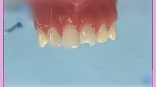 باندینگ دندان ها برای ترمیم دندان های آسیب دیده