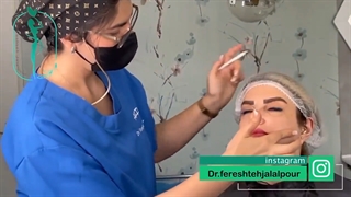 فیلم لیفت صورت با نخ آپتوس | دکتر فرشته جلالپور