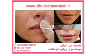 زیبایی لب ها در طب سنتی
