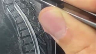 اهمیت درمان تنگی کانال گردن