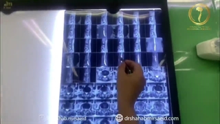 عدم درمان درست و دقیق پوکی استخوان