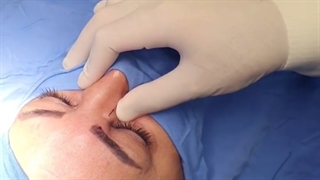 آموزش تزریق بی حسی موضعی در جراحی مجرای اشکی