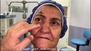 جراحی تومور همانژیوم کاورنوس