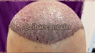 نتیجه کاشت مو یک روزه 09336093000 گرگان گنبد کردکوی بهشهر بندرگز