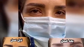 جای بخیه بلفاروپلاستی