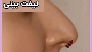 لیفت با نخ بهتر است یا ژل؟