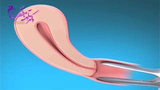 انیمیشن جلوگیری از بارداری و IUD