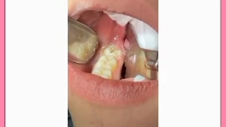 دندان درد و کشیدن دندان