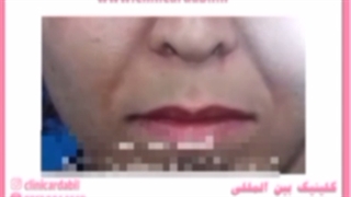 پس از لیفت لب چه نکاتی را باید رعایت کرد؟