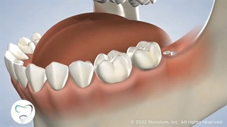 جراحی دندان عقل