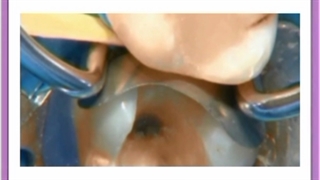 اهمیت پر کردن دندان چیست؟