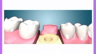 آشنایی با روش های کاشت دندان