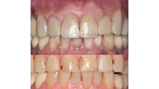 اصلاح طرح لبخند با از بین بردن زردی دندان‌ها با کامپوزیت | سیمادنت