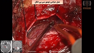 عمل جراحی تومور سی پی انگل