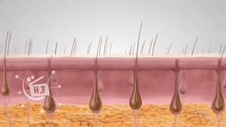 نحوه عملکرد دستگاه لیزر موهای زائد و تاثیر آن بر پوست و مو