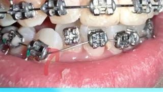 نکات ارتودنسی