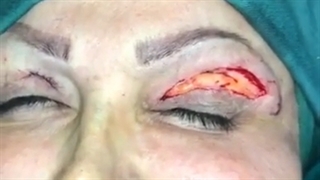 جراحی پلک زیبایی و جراحی پلک درمانی