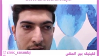 لیفت بینی با نخ در خانه