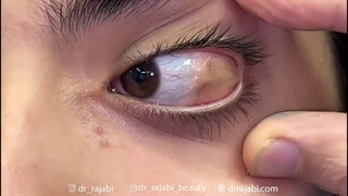 جراحی توده لیپودرموئید
