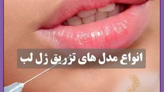 بهترین کلینیک زیبایی برای تزریق ژل لب مدل عروسکی یا باربی
